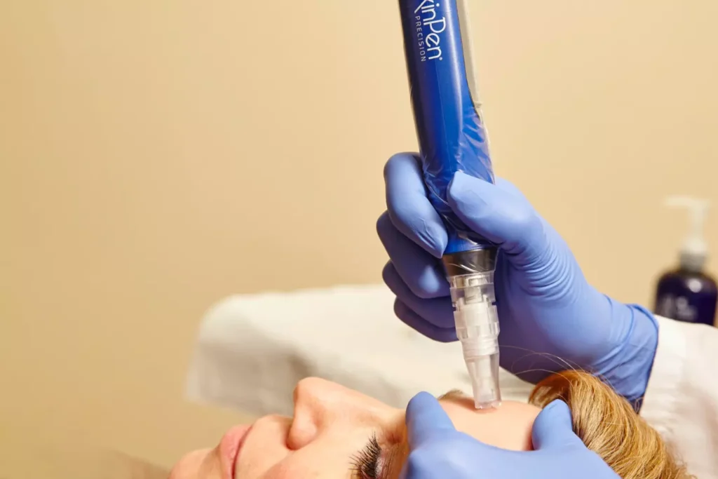 Skinpen Microneedling in Park Ridge IL
